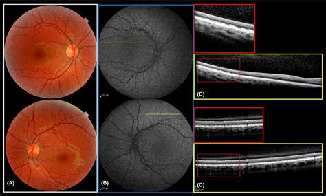 Fundus Autofluorescence Imaging In Hereditary Retinal Diseases Pichi