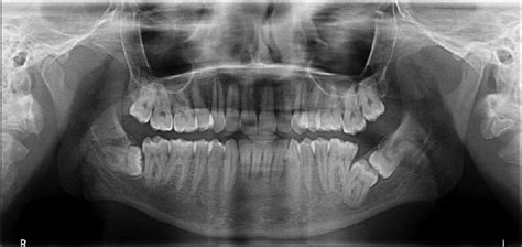 Orthopantomograph Showing Impacted Kissing Molars Second And Third