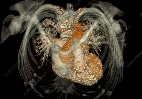 Healthy Heart Ct Scan Stock Image C0577918 Science Photo Library