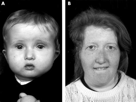 Digeorge Syndrome Facial Features