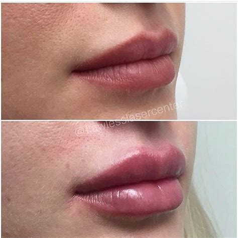 This Client Was Treated With One Full Syringe Of Vollure Juvederm Xc To