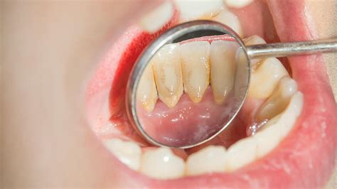 Plaque Zahnbelag Entfernen Und Vorbeugen