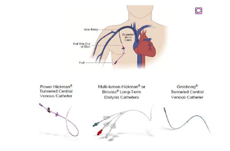 Types Of Venous Access Devices