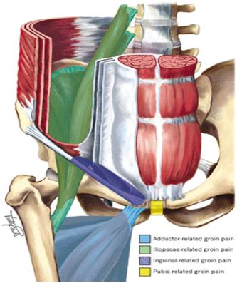 Muscles and tendons in the hip. Do you suffer with Groin Pain?