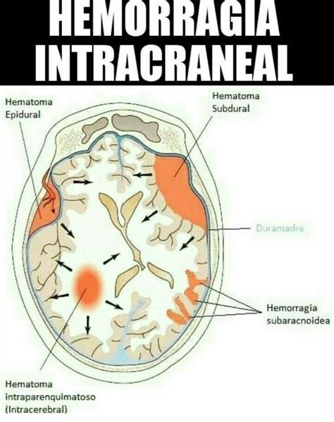 HEMORRAGIAS INTRACRANEALES Hemorragia Intracraneal Hemorragia