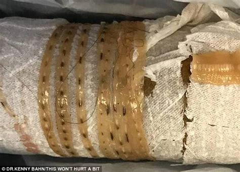 California Man Discovers He Had A 5ft Tapeworm Inside Him Daily Mail