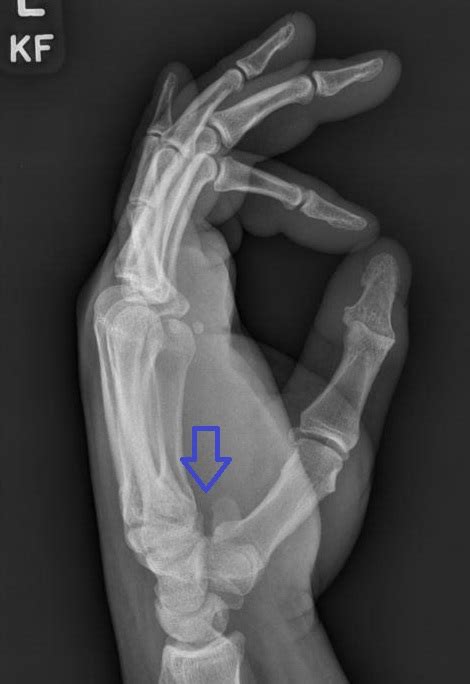 Hamate Fracture Wikiprojectmed