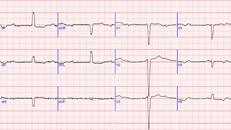 Ecg Showing Complete Third Degree Atrioventricular Block With Left