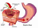 Gastric Intestinal Doctor Pictures