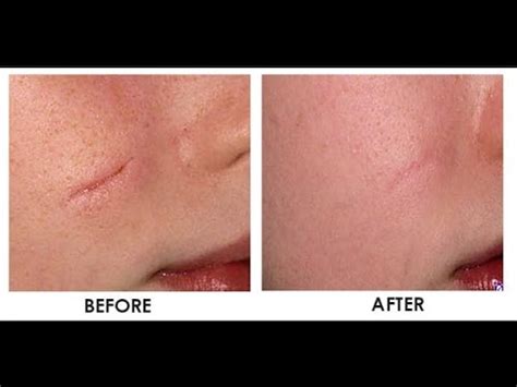 How To Remove Scars From Your Face In Just Two Weeks Youtube