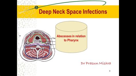 Deep Neck Space Infections Part I Anatomy And Quinsy Youtube