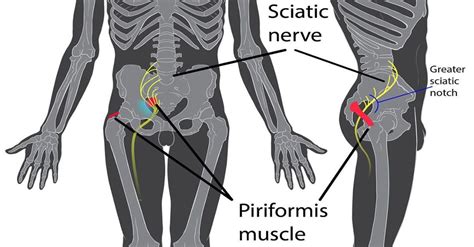Pin On Pinched Nerve In Lower Back