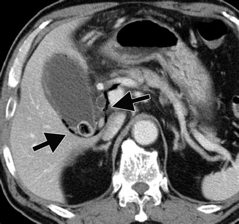 The Perihepatic Space Comprehensive Anatomy And Ct Features Of