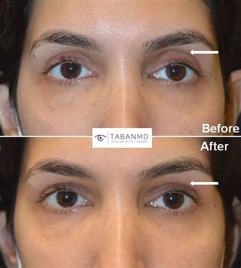 Almond Eye Surgery Before And After Gallery Taban Md
