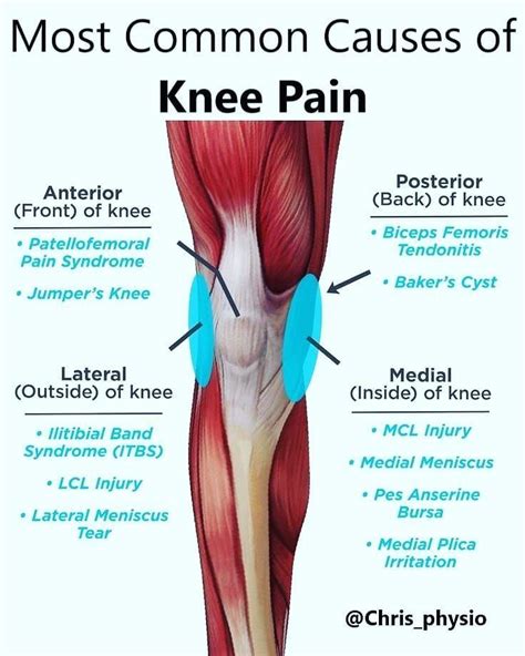 Knee Pain Location Chart Bursitis