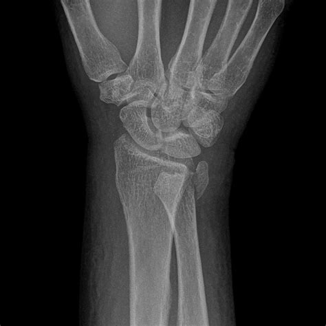 Locked Volar Distal Radioulnar Joint Dislocation Associated With Asymptomatic Transection Of The