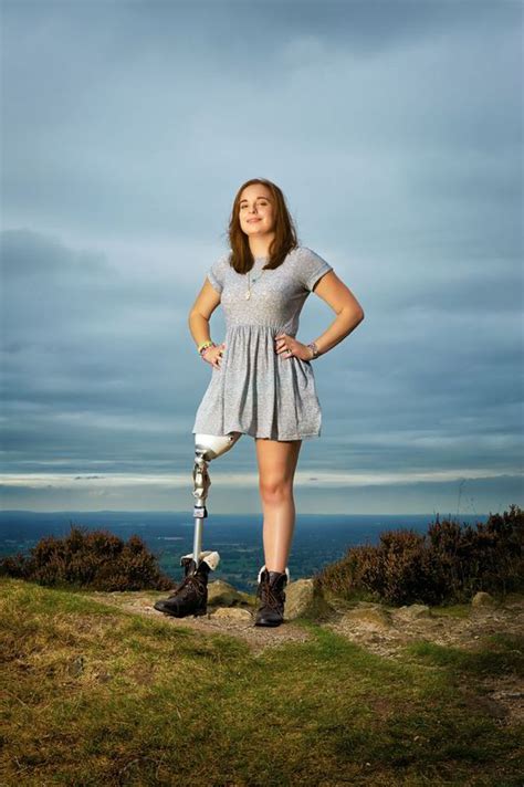 Olivia Cork Lost Her Leg To Bone Cancer Health Life