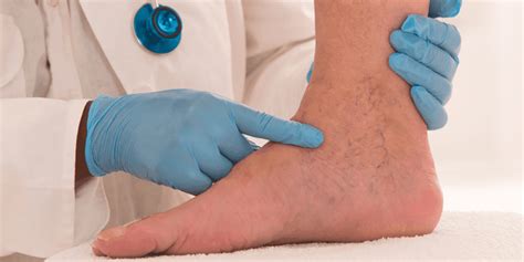 Benefits Of Radiofrequency Ablation Rfa For Varicose Veins San Diego