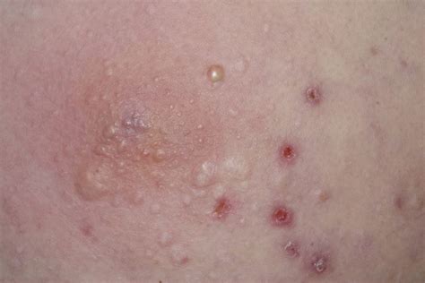 Severe Cutaneous Drug Reaction To Hydroxychloroquine Delineated