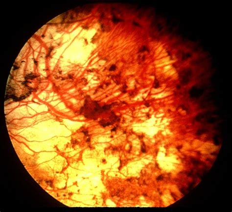 Choroidal Atrophy Retina Image Bank