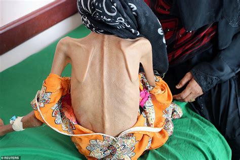 Yemeni Girl 12 Weighing Just 22lbs One Of Millions Starving The Projects World