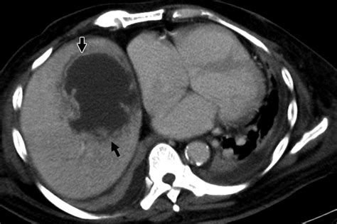 Ct Appearance Of Pyogenic Liver Abscesses Caused By Klebsiella