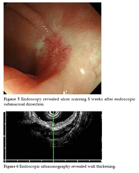 The Healing Process Of Artificial Colorectal Ulcers After Endoscopic Submucosal Dissection