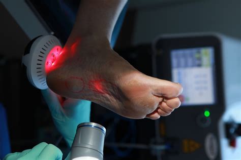 Laser Pain Therapy Ottawa Foot Clinic