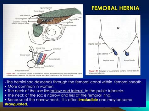 Femoral Hernia Diagram