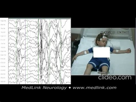 Epilepsy With Myoclonic Absences Medlink Neurology