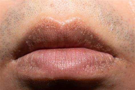 Tiny White Spots Under Skin On Lips