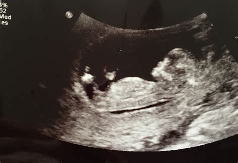 12 Week Ultrasound Boy Or Girl Please Help