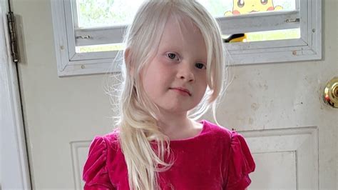 Petition · Recognize Albinism As A Disability For Tax Credit Canada