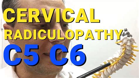 What Is C5 C6 Radiculopathy What Causes Cervical Radiculopathy Dr