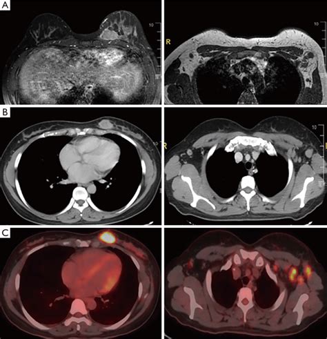The Images Of Breast And Axillary Lymph Nodes Mri A Ct B And