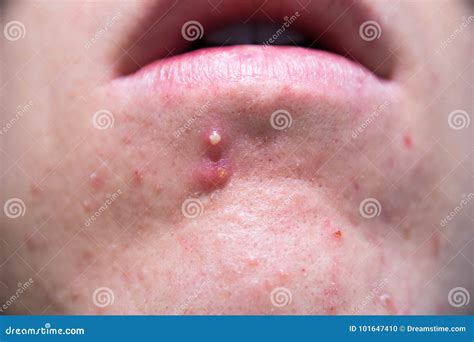 White Chin Pimple Stock Photo Image Of Unhealthy Blemish 101647410