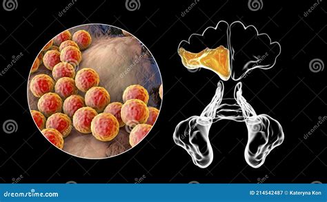 Purulent Inflammation Of Right Frontal Sinus And Close Up View Of