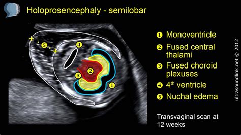 Semilobar Holoprosencephaly 2d And 3d Ultrasound Youtube