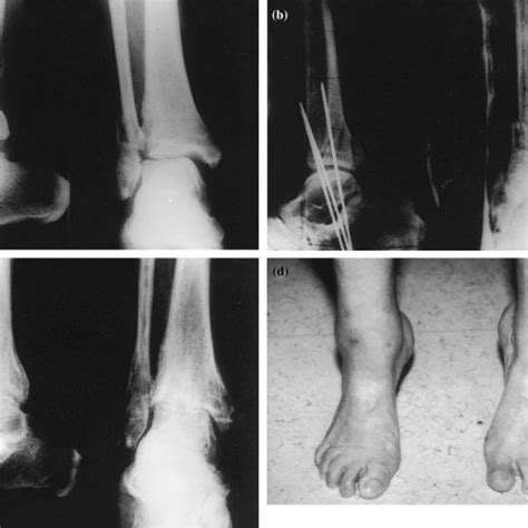Patient No 13 Mh A 68 Year Old Woman A Radiographs Of The