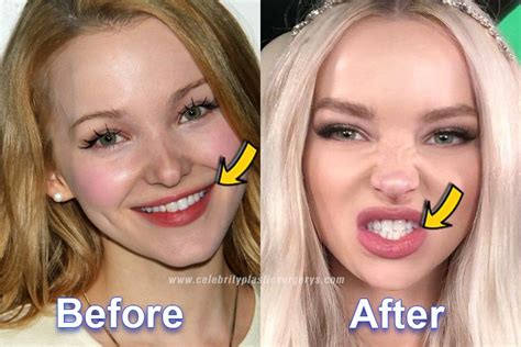 Dove Cameron Plastic Surgery Before And After With Pics