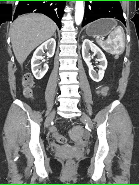 Ovarian Cancer And Carcinomatosis Obgyn Case Studies Ctisus Ct