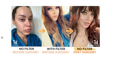 'i'd pick at my skin until i drew blood body dysmorphia is a mental health condition, in which the person dealing with it worries extensively i bought size 10 jeans and got blonde highlights, and when i came home for christmas. Snapchat Dysmorphia Plastic Surgery at ID HOSPITAL KOREA