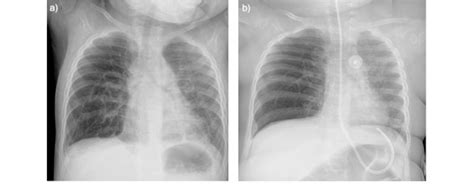 Serial Chest Radiographs From Case 2 Performed At A 8 Months Of Age