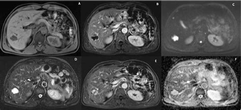 Figure 6 From Hepatic Hemangiomas Typical And Atypical Imaging
