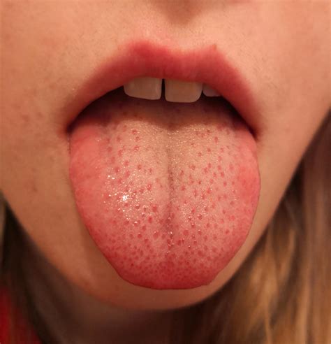 Weiße Punkte auf meiner Zunge? (Gesundheit und Medizin, Krankheit)
