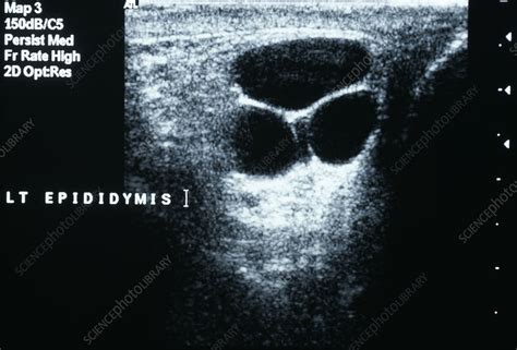 Testicular Cysts Ultrasound Scan Stock Image M8650216 Science