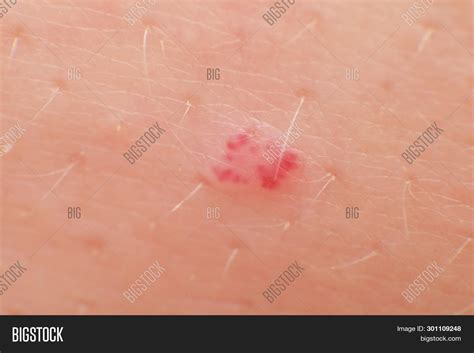 At the later stage, an angioma picture is more in bright red, oval or round. Cherry Angiomas Image & Photo (Free Trial) | Bigstock