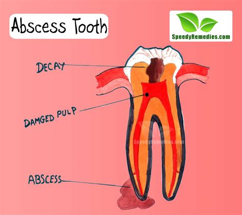 How To Cure An Abscess Tooth At Home Grizzbye