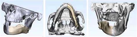Peek Implant Htr Prosthesis For Cranioplasty Using Creatbot Technology