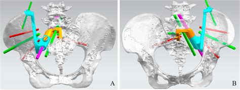 Frontiers Reconstruction After Hemisacrectomy With A Novel 3d Printed